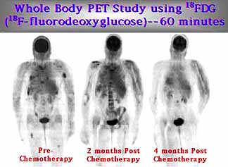 Pre-treatment and post-treatment PET Scan via Acrin