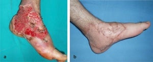 The result of a skin graft. (Source)