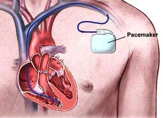 An artificial pacemaker placed under the skin, with an electrical wire fed into the heart. (Credit: greenscienceking.wikispaces.com)