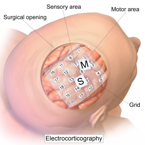 Intracranial_electrode_grid_for_electrocorticography