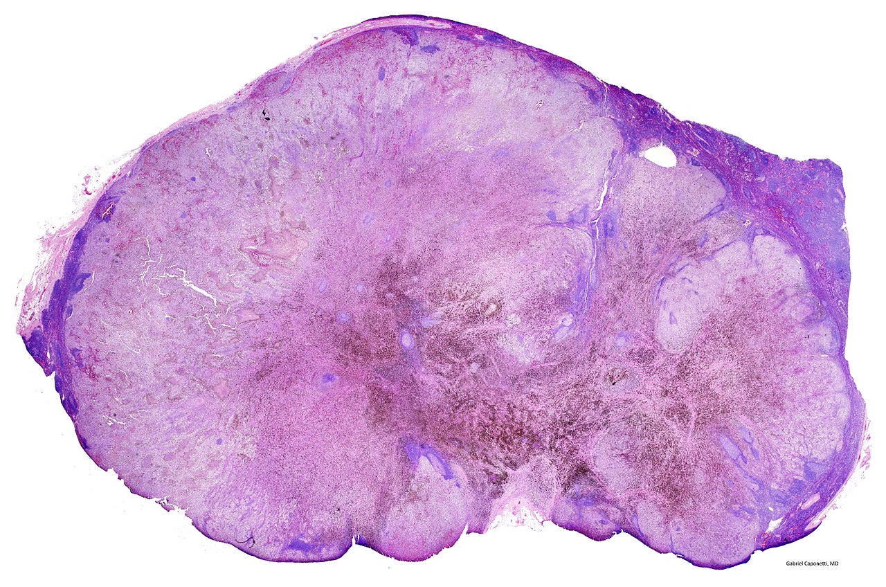 Lymph node almost completely replaced by metastatic melanoma. Credit: Gabriel Caponetti, MD