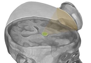 The researchers targeted the thalamus with low-intensity focused ultrasound pulsation. - UCLA Newsroom