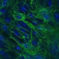 During the natural scarring process, collagen proteins (green) in fibroblasts from a Dupuytren patient crosslink together. (Image source: Iyer Lab)