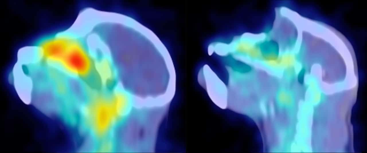 This SIV-infected monkey shows far less virus (red-yellow) after treatment with an antibody to α4ß7 (right). Philip J. Santangelo/Francois Villinger