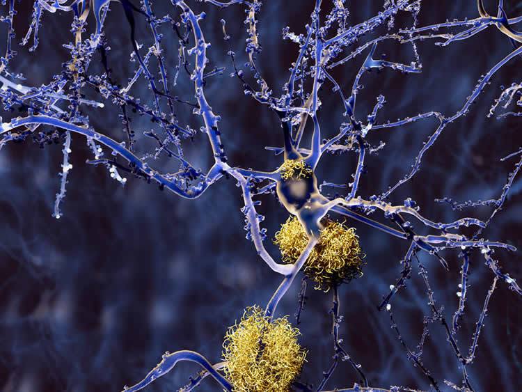 Amyloid plaques on a neuron. Credit: TUM/Juan Gärtner