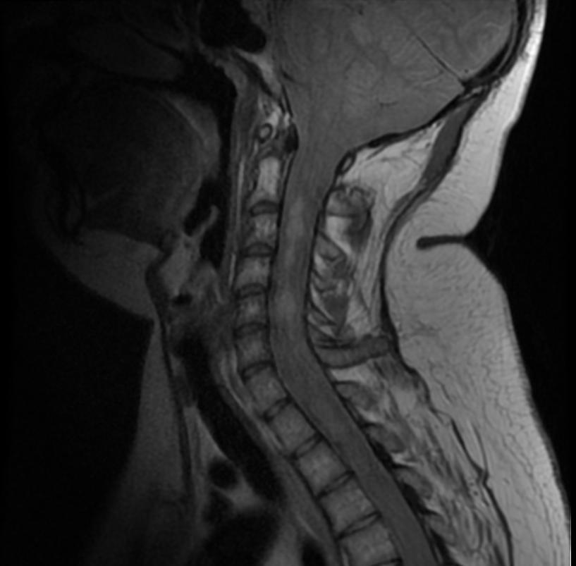 Intramedullary ependymomas. WikiMedia Commons.