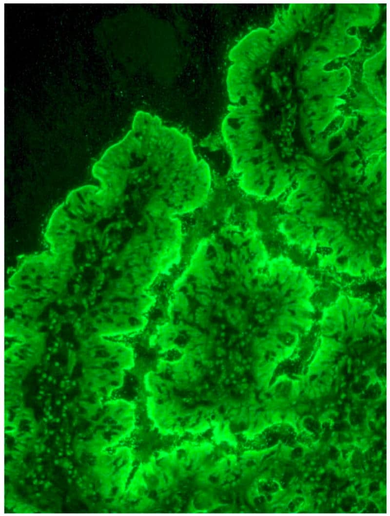 Indirect immunofluorescence on a patient's intestinal lining shows anti-enterocyte antibodies. Enterocytes are the cells of the intestinal lining. Credit:NIH/ Akram S., et al.