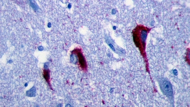 Neurofibrillary tangles of tau protein in the hippocampus of an old person with Alzheimer’s-related pathology. WikiMedia.