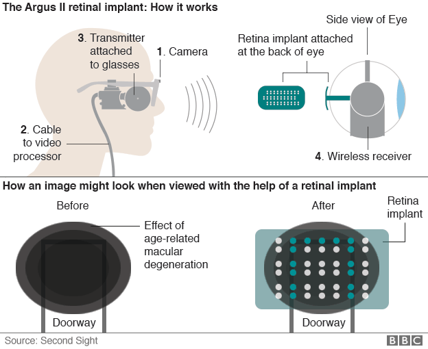 How the Argus II retinal implant operates. Credit: BBC