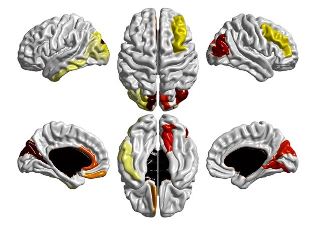 autism autism spectrum genetics mri children with autism developmental disorder