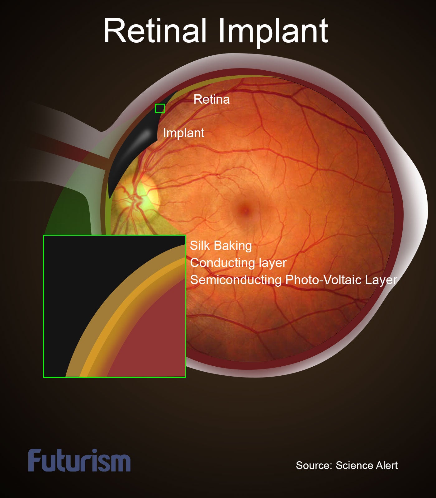 retinal-implant-futurism