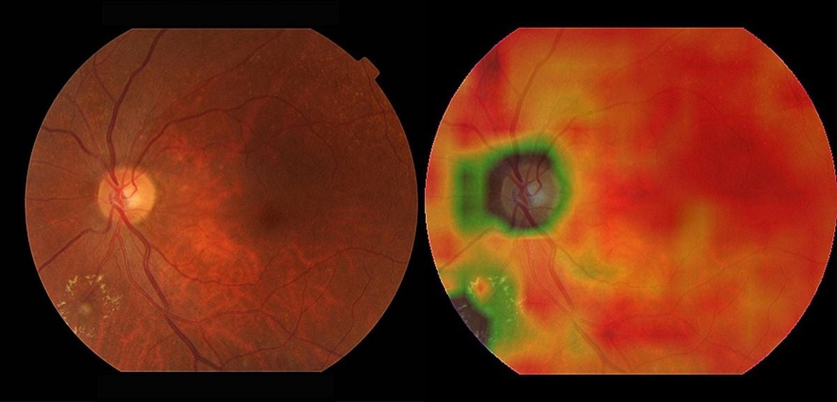 Two eye images showing damage in patches of green and brown. A medical AI program has been trained to rapidly recognize disease on images like this one.