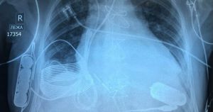 Doctors have implanted the first wireless heart pump in a patient, eliminating the need for him to be connected to a power source via a driveline.