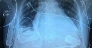 Doctors have implanted the first wireless heart pump in a patient, eliminating the need for him to be connected to a power source via a driveline.