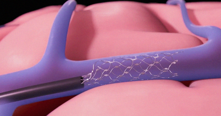 This Neural Implant Accesses Your Brain Through the Jugular Vein
