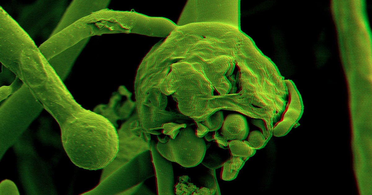Deadly Brain-Eating Fungus Outbreak Spreads Beyond India